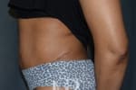 HR Plastic Surgery - Tummy Tuck patient after 10