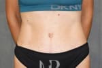 HR Plastic Surgery - Tummy Tuck patient after 11