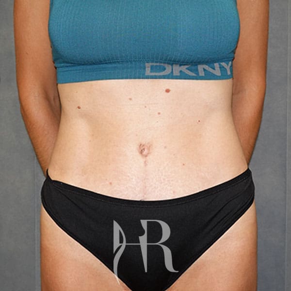 HR Plastic Surgery - Tummy Tuck patient after 11