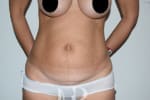 HR Plastic Surgery - Tummy Tuck patient before 3
