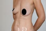 HR Plastic Surgery - Tummy Tuck patient before 12