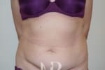HR Plastic Surgery - Tummy Tuck patient before 14