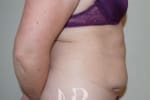 HR Plastic Surgery - Tummy Tuck patient before 15