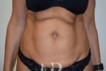 HR Plastic Surgery - Tummy Tuck patient before 16