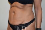 HR Plastic Surgery - Tummy Tuck patient before 17