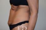 HR Plastic Surgery - Tummy Tuck patient before 18