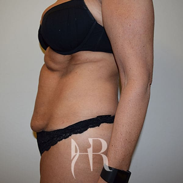 HR Plastic Surgery - Tummy Tuck patient before 18