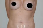 HR Plastic Surgery - Tummy Tuck patient before 19