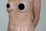HR Plastic Surgery - Tummy Tuck patient before 20