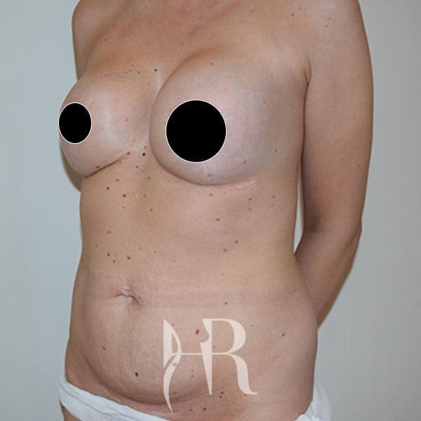 HR Plastic Surgery - Tummy Tuck patient before 20