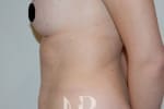 HR Plastic Surgery - Tummy Tuck patient before 21