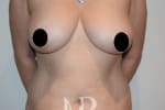 HR Plastic Surgery - Tummy Tuck patient before 22
