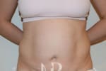 HR Plastic Surgery - Tummy Tuck patient before 23