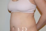 HR Plastic Surgery - Tummy Tuck patient before 24