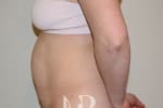 HR Plastic Surgery - Tummy Tuck patient before 25