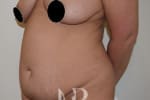 HR Plastic Surgery - Tummy Tuck patient before 7