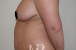 HR Plastic Surgery - Tummy Tuck patient before 8