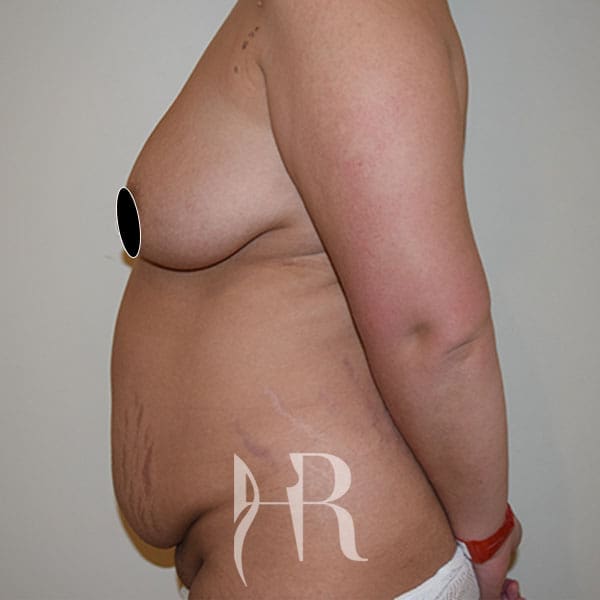 HR Plastic Surgery - Tummy Tuck patient before 8