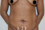 HR Plastic Surgery - Tummy Tuck patient before 9