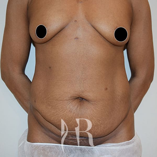 HR Plastic Surgery - Tummy Tuck patient before 9
