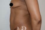 HR Plastic Surgery - Tummy Tuck patient before 10