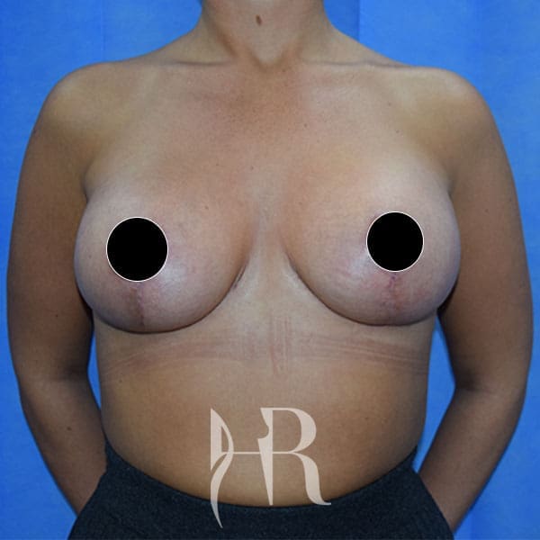 HR Plastic Surgery - Breast Enlargement With Uplift patient after 4