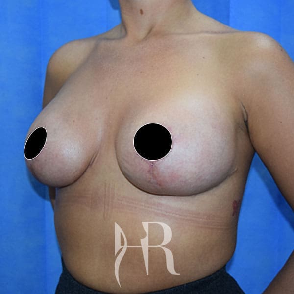 HR Plastic Surgery - Breast Enlargement With Uplift patient after 5