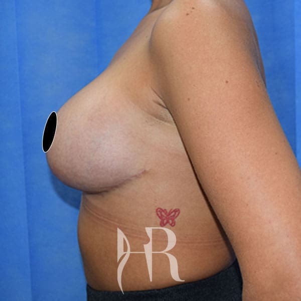 HR Plastic Surgery - Breast Enlargement With Uplift patient after 6