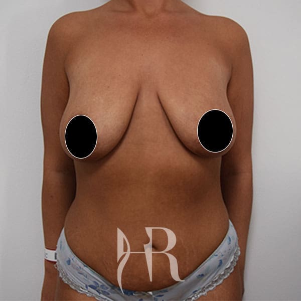 HR Plastic Surgery - Breast Enlargement With Uplift patient before 4