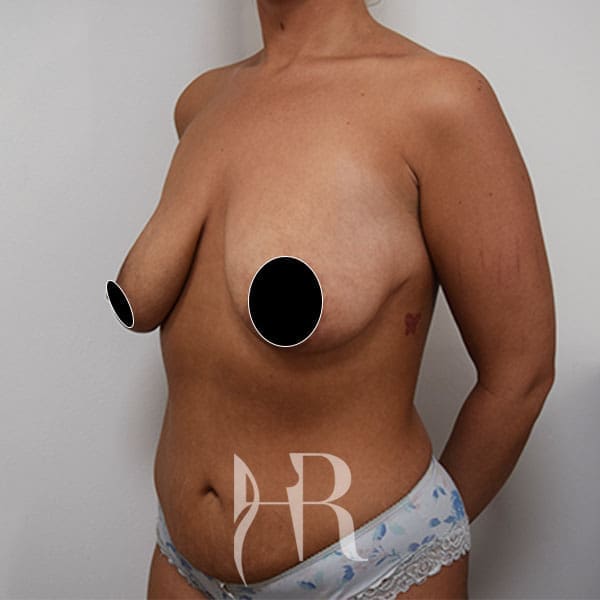 HR Plastic Surgery - Breast Enlargement With Uplift patient before 5