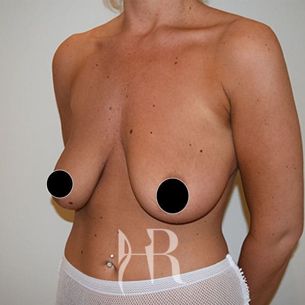 HR Plastic Surgery - Breast Enlargement With Uplift patient before 2
