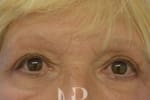 HR Plastic Surgery - Eyelid Surgery (Blepharoplasty) patient after 1