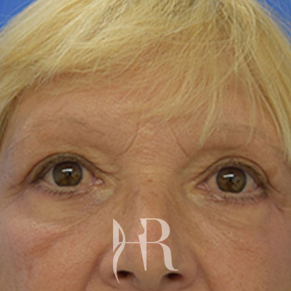 HR Plastic Surgery - Eyelid Surgery (Blepharoplasty) patient after 1