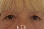 HR Plastic Surgery - Eyelid Surgery (Blepharoplasty) patient before 1