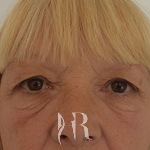 HR Plastic Surgery - Eyelid Surgery (Blepharoplasty) patient before 1