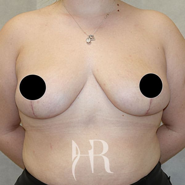 HR Plastic Surgery - Breast Asymmetry patient after 1