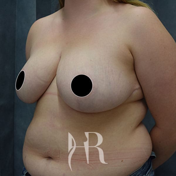 HR Plastic Surgery - Breast Reduction patient after 5