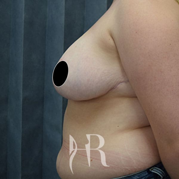 HR Plastic Surgery - Breast Reduction patient after 6