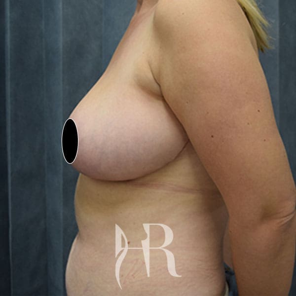 HR Plastic Surgery - Breast Reduction patient after 10