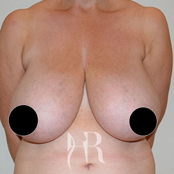 HR Plastic Surgery - Breast Reduction patient before 8