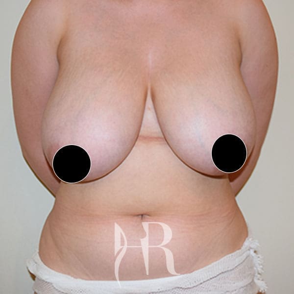 HR Plastic Surgery - Breast Reduction patient before 11