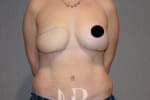 HR Plastic Surgery - Breast Reconstruction patient after 7