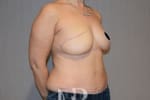 HR Plastic Surgery - Breast Reconstruction patient after 6