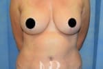 HR Plastic Surgery - Breast Reconstruction patient after 4
