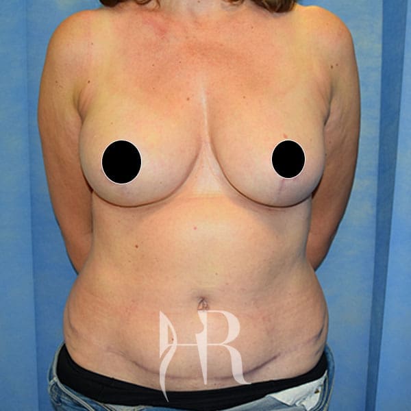 HR Plastic Surgery - Breast Reconstruction patient after 4