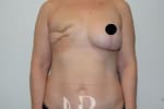 HR Plastic Surgery - Breast Reconstruction patient before 7