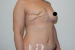HR Plastic Surgery - Breast Reconstruction patient before 6