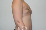 HR Plastic Surgery - Breast Reconstruction patient before 5