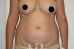 HR Plastic Surgery - Breast Reconstruction patient before 4