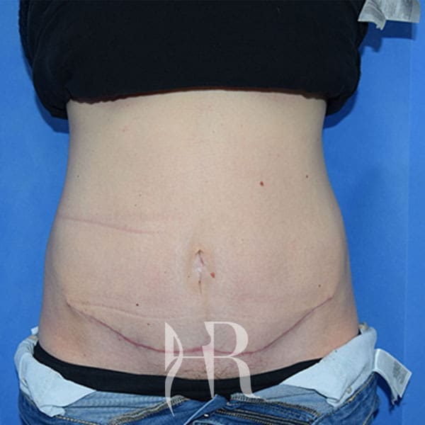 HR Plastic Surgery - Diastasis Recti Surgery patient after 1